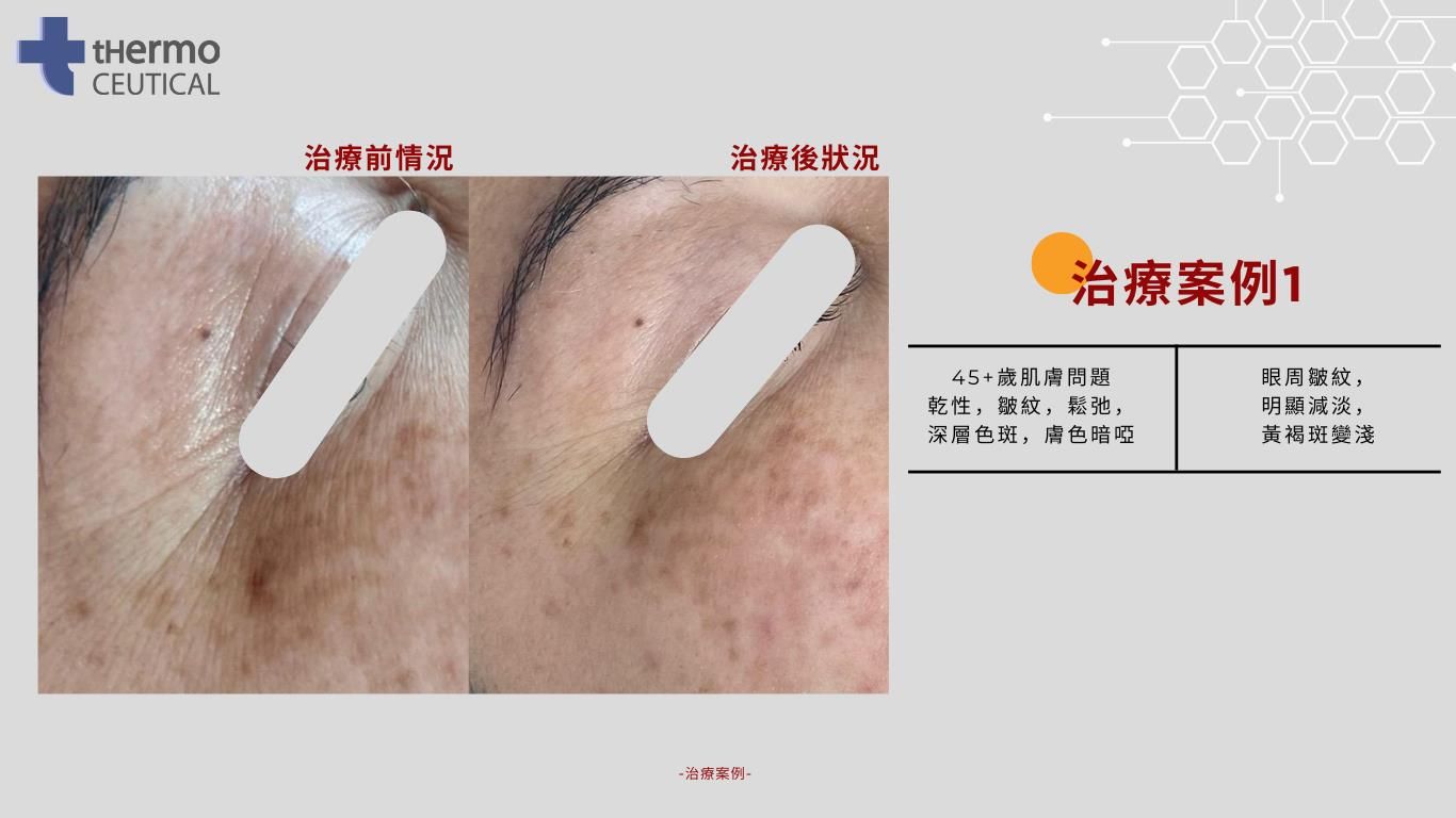 EXOSOME PEEL 被業界稱為生美版Thermage，能逆轉肌膚年齡激活細胞加強屏障，更針對顯老頸紋