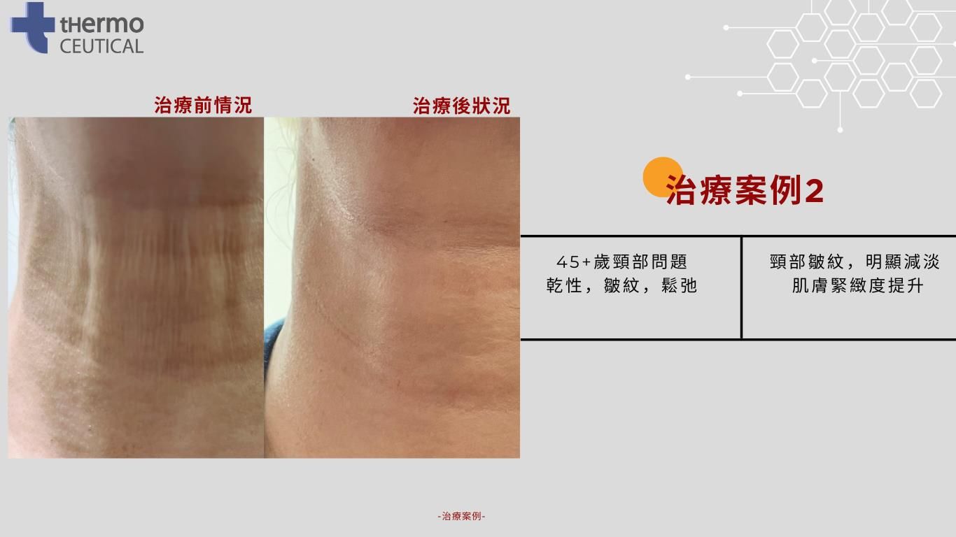 EXOSOME PEEL 被業界稱為生美版Thermage，能逆轉肌膚年齡激活細胞加強屏障，更針對顯老頸紋