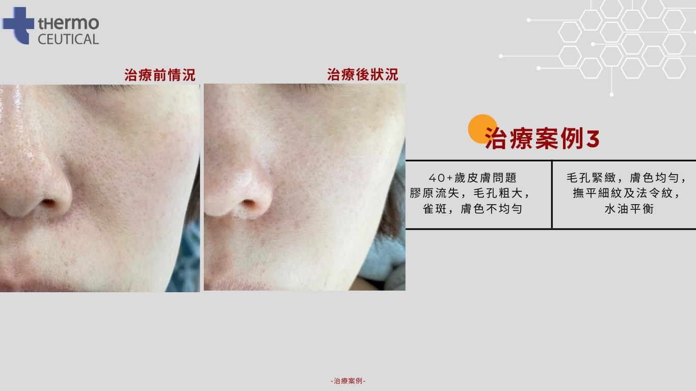 EXOSOME PEEL 被業界稱為生美版Thermage，能逆轉肌膚年齡激活細胞加強屏障，更針對顯老頸紋