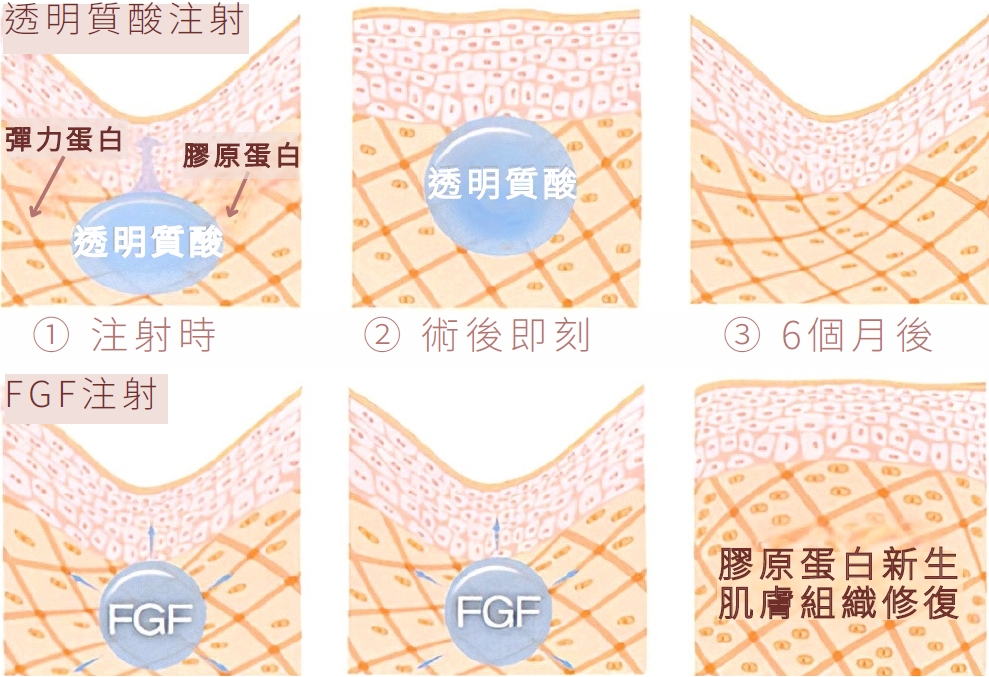 黃金線美容術與 FGF 注射雙效療程｜非整形自然緊緻 -stagemarketing日本韓國皮膚科專用醫學美容品牌