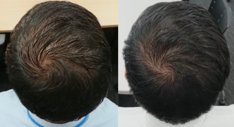 DR.SCALP 日本豌豆芽生髮補充劑