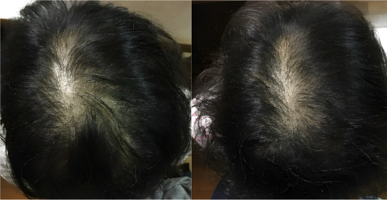DR.SCALP 日本豌豆芽生髮補充劑